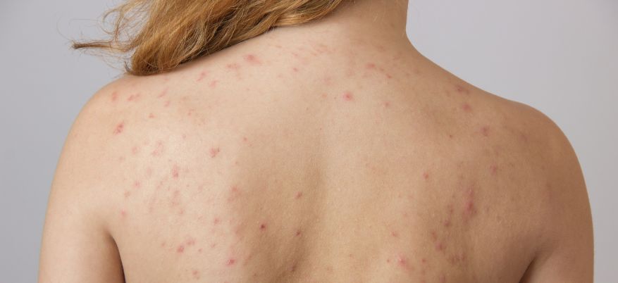 Acne sulla schiena: cause, rimedi e prevenzione