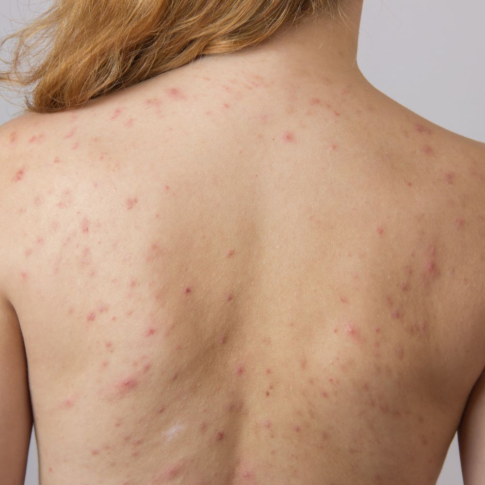 Acne sulla schiena: cause, rimedi e prevenzione